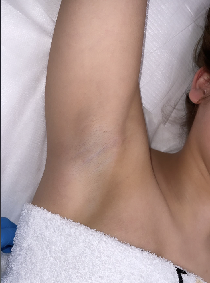 Behandelde oksel na een eerste sessie laserontharing